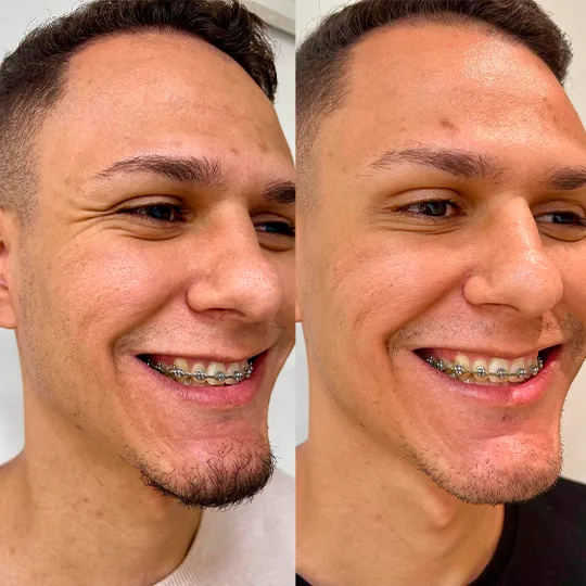 Antes e Depois
